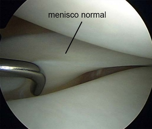 rodilla degeneración menisco saludable