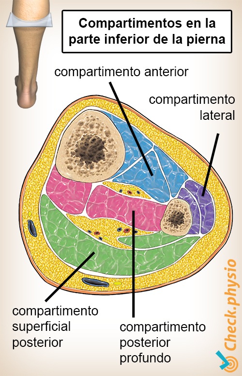 síndrome compartimental de la parte inferior de la pierna sección transversal de los músculos