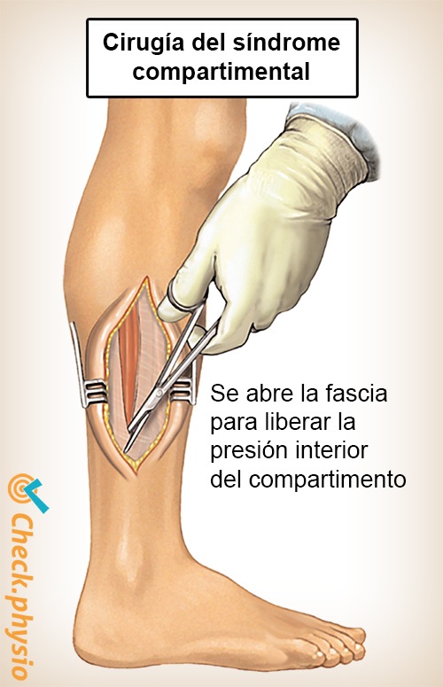 cirugía del síndrome compartimental de la parte inferior de la pierna
