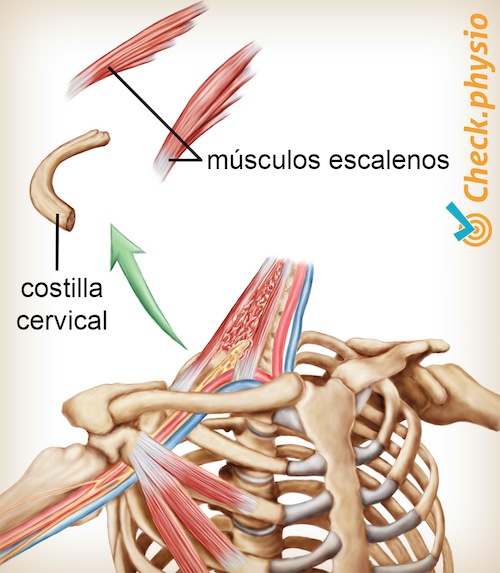 hombro brazo mano síndrome de salida torácica costilla cervical