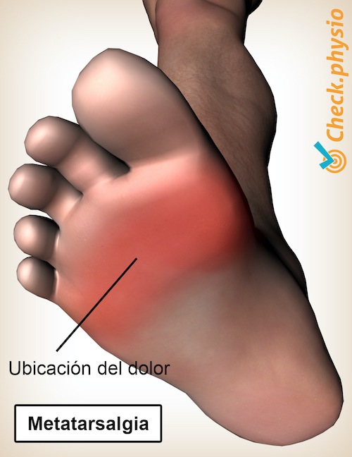 pie metatarsalgia ubicación del dolor