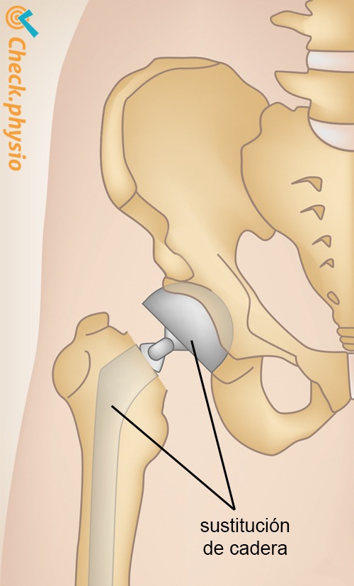 fractura de cadera prótesis
