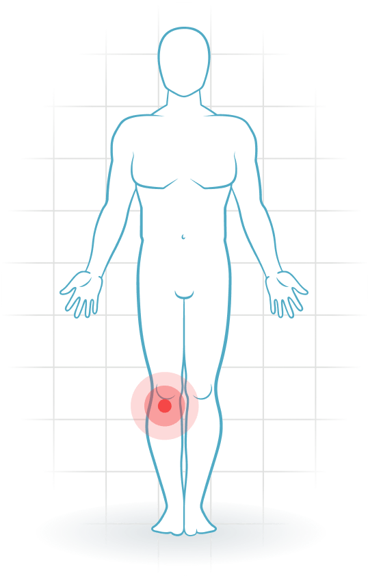 pijnlocatie Osgood-Schlatter