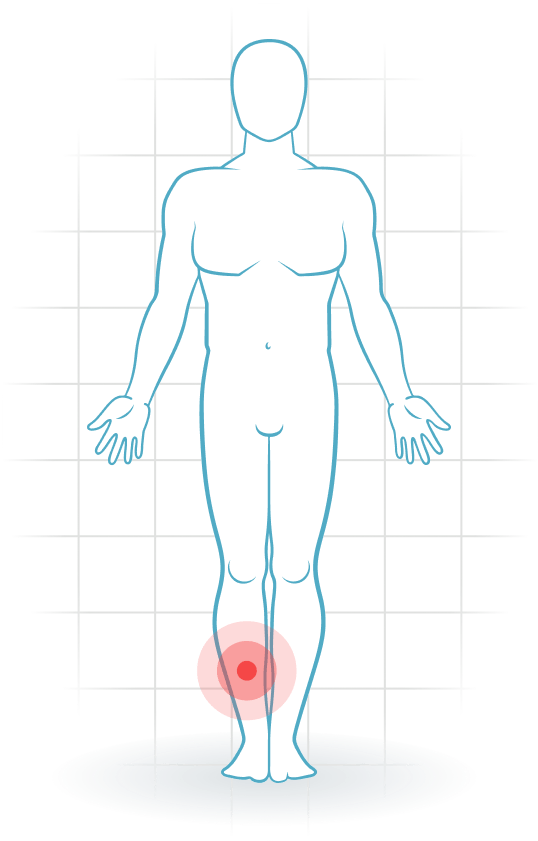 pijnlocatie Síndrome de estrés tibial medial